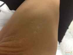 六盘水治白癜风